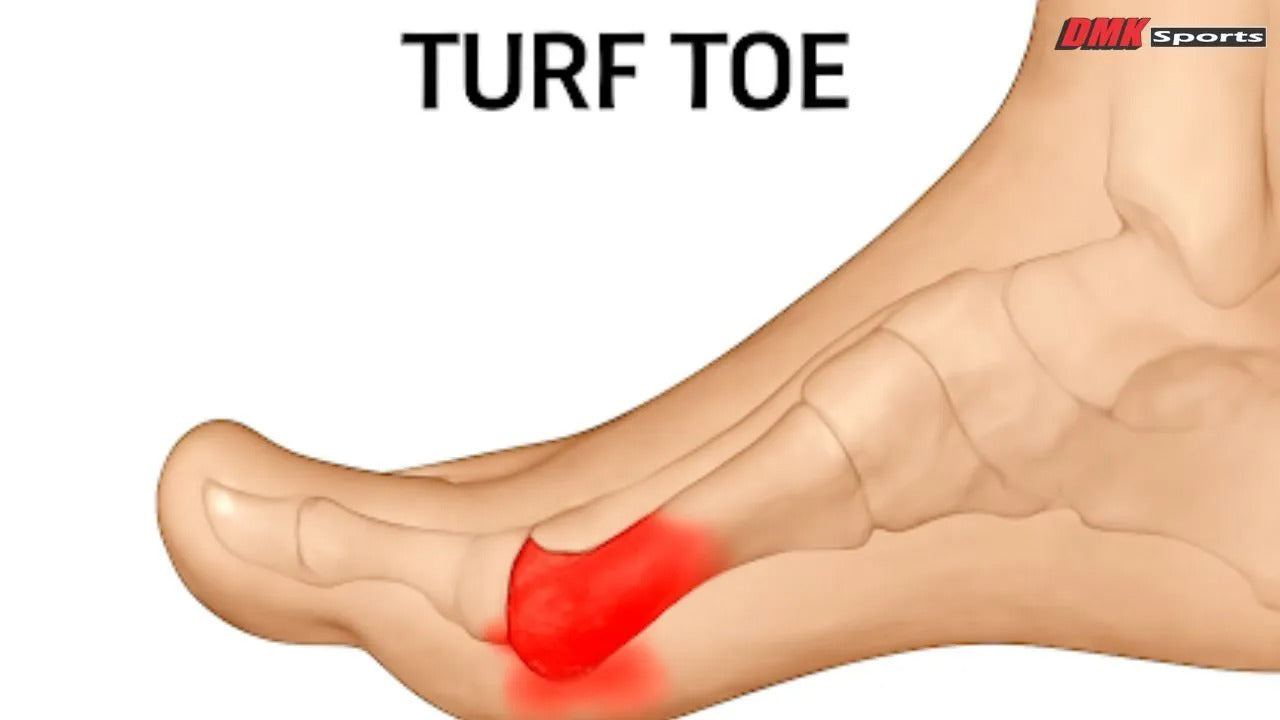 Can I Still Play Soccer with Turf Toes?